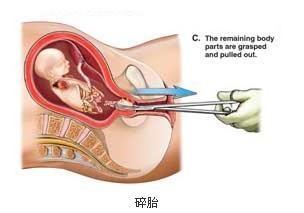 做流产的视频,真实视频解析